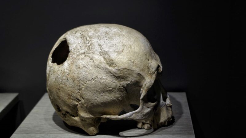 Humanos andavam com buracos de 5 centímetros no crânio há 10 mil anos